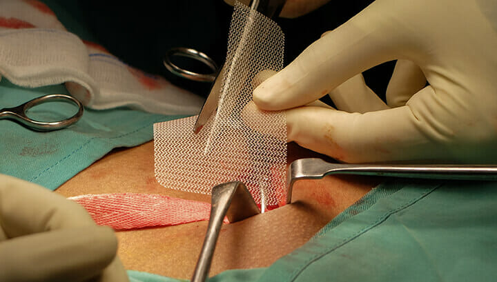 Hernia Surgery Treatment with Mesh